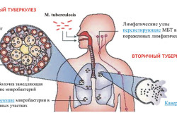 Механизмы возникновения и развития туберкулеза