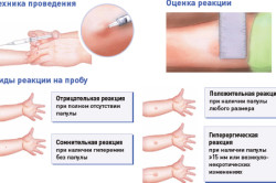 Оценка результатов БЦЖ