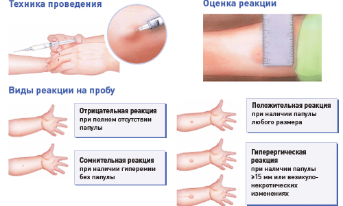 Оценка реакции Манту