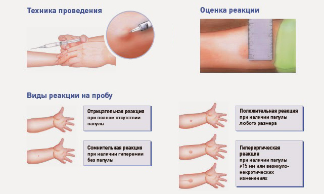 Оценка результатов БЦЖ
