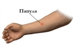 Папула после пробы Манту Папула после пробы Манту