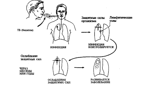 Развитие туберкулеза