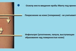 Реакцию на туберкулин при пробе Манту