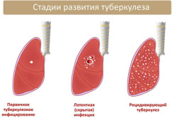 Стадии развития туберкулеза