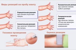 Виды реакций на пробу манту
