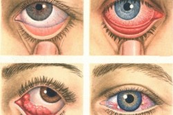 Виды глазного туберкулеза