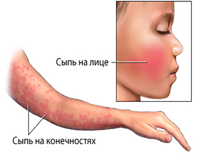Аллергическая реакция на Манту