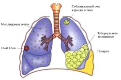 Легкие, пораженные туберкулезом