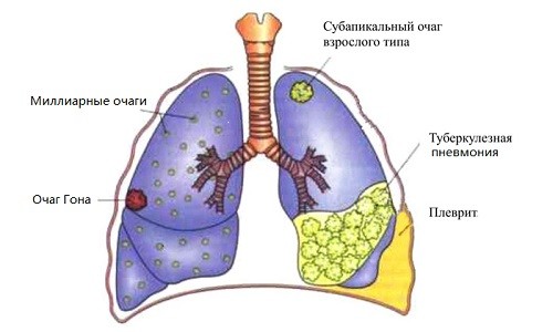 Легкие, пораженные туберкулезом Легкие, пораженные туберкулезом