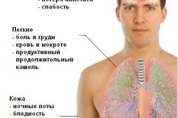Симптомы туберкулеза Симптомы туберкулеза