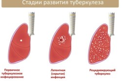 Стадии туберкулеза