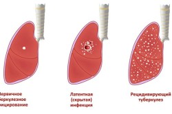 Стадии развития туберкулеза