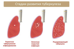 Стадии туберкулеза