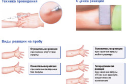 Техника проведения Манту и оценка результата