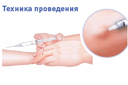 Техника проведения Манту