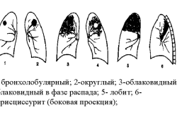 Типы туберкулеза легких Типы туберкулеза легких