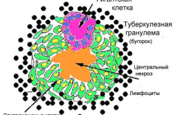 Схема туберкулезной гранулемы