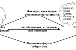 Причины возникновения диссеминированного туберкулеза