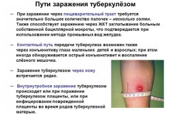 Заражение туберкулезом