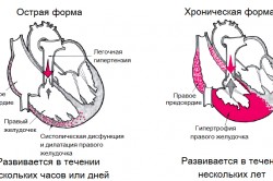 Легочное сердце