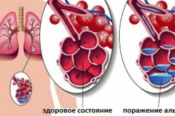 Острая крупозная пневмония