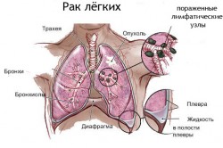 Рак легких