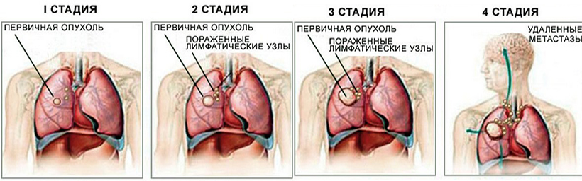 Стадии рака легких Стадии рака легких