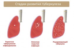 Стадии развития туберкулеза