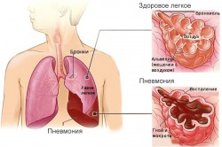 Вирусное воспаление легких